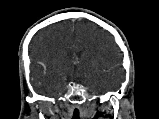 Cerebral arteriovenous malformation (Radiopaedia 78188-90746 Coronal C+ delayed 53).jpg