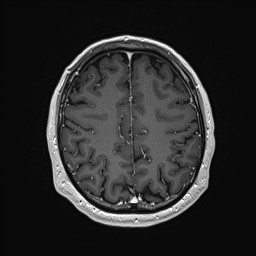 Cerebral arteriovenous malformation (Radiopaedia 84015-99245 Axial T1 C+ 116).jpg