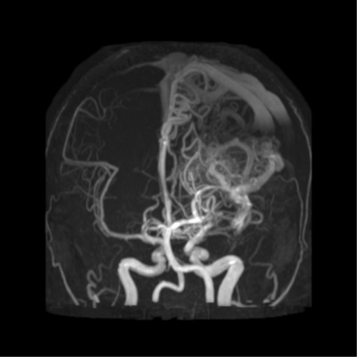File:Cerebral arteriovenous malformation - huge (Radiopaedia 35734-37272 MRA 19).png