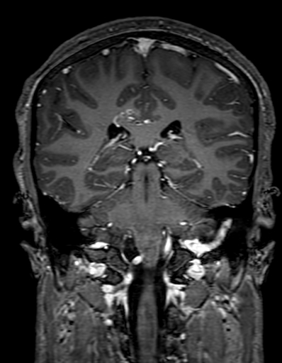 Cerebral arteriovenous malformation at posterior body of corpus callosum (Radiopaedia 74111-84925 K 231).jpg