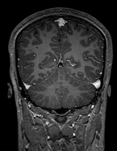 Cerebral arteriovenous malformation at posterior body of corpus callosum (Radiopaedia 74111-84925 K 273).jpg