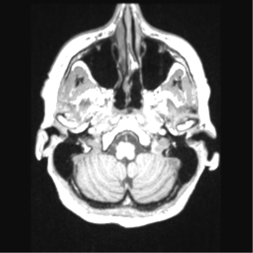 File:Cerebral arteriovenous malformation with hemorrhage (Radiopaedia 34422-35737 Axial T1 13).png