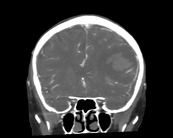 Cerebral arteriovenous malformation with lobar hemorrhage (Radiopaedia 44725-48511 A 21).png