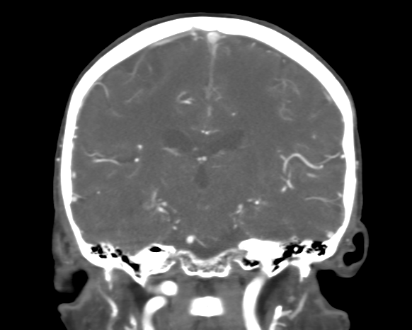 Cerebral arteriovenous malformation with lobar hemorrhage (Radiopaedia 44725-48511 A 33).png