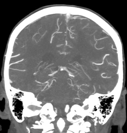 Cerebral arteriovenous malformation with lobar hemorrhage (Radiopaedia 44725-48511 B 37).png