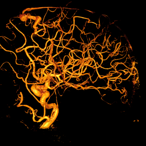 Cerebral arteriovenous malformation with lobar hemorrhage (Radiopaedia 44725-48513 Lateral 45).png