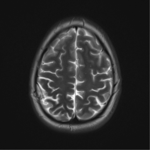File:Cerebral cavernoma and development venous anomaly (Radiopaedia 37603-39482 Axial T2 18).png