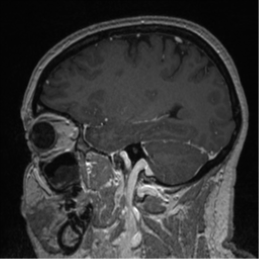 File:Cerebral cavernoma and development venous anomaly (Radiopaedia 37603-39482 Sagittal T1 C+ 66).png