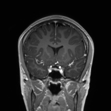 Cerebral cavernous venous malformation (Radiopaedia 70008-80021 Coronal T1 C+ 39).jpg