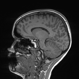 File:Cerebral cavernous venous malformation (Radiopaedia 70008-80021 Sagittal T1 32).jpg