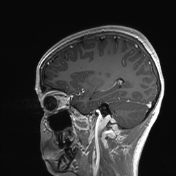 Cerebral cavernous venous malformation (Radiopaedia 70008-80021 Sagittal T1 C+ 50).jpg