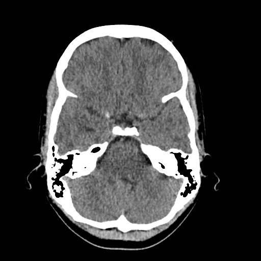 Cerebral cavernous venous malformation (Radiopaedia 70008-80022 Axial non-contrast 12).jpg