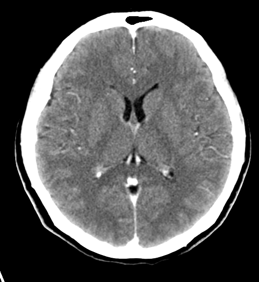 File:Cerebral cavernous venous malformations (Radiopaedia 48117-52945 Axial C+ delayed 19).png