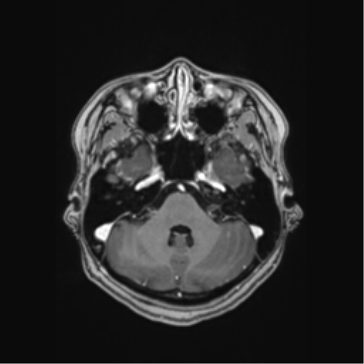 Cerebral cavernous venous malformations (Radiopaedia 48117-52946 Axial T1 C+ 10).png
