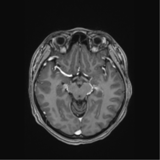 Cerebral cavernous venous malformations (Radiopaedia 48117-52946 Axial T1 C+ 23).png