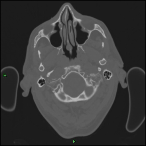 Cerebral contusions (Radiopaedia 33868-35039 Axial bone window 15).jpg