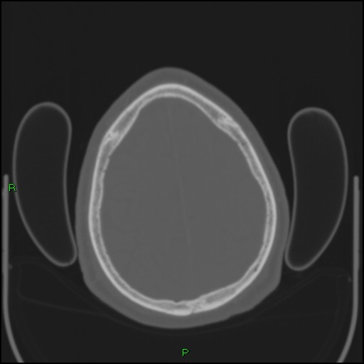 Cerebral contusions (Radiopaedia 33868-35039 Axial bone window 179).jpg