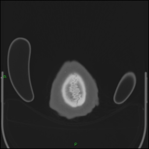 Cerebral contusions (Radiopaedia 33868-35039 Axial bone window 223).jpg