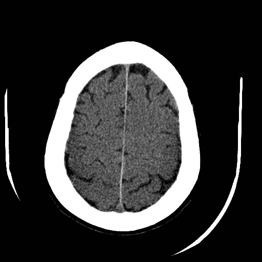 File:Cerebral edema (evolution in time) (Radiopaedia 19418-19440 non-contrast 77).jpg