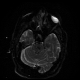Cerebral embolic infarcts (embolic shower) (Radiopaedia 49837-55108 Axial DWI 34).jpg