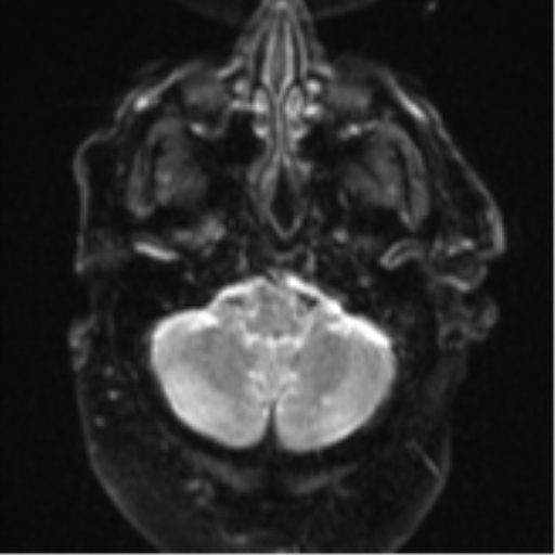 File:Cerebral embolic infarcts (embolic shower) (Radiopaedia 57395-64342 Axial DWI 7).png