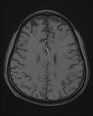 Cerebral embolic infarcts (embolic shower) (Radiopaedia 72391-82921 Axial MRA 141).jpg