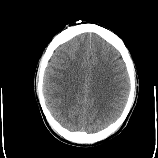 File:Cerebral hemorrhagic contusions- temporal evolution (Radiopaedia 40224-42754 Axial non-contrast 20).png