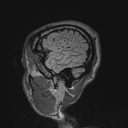 File:Cerebral hemorrhagic contusions- temporal evolution (Radiopaedia 40224-42757 Sagittal T1 13).png