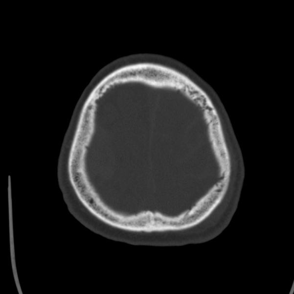 Cerebral hemorrhagic contusions (Radiopaedia 23145-23188 Axial bone window 50).jpg