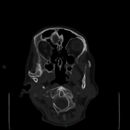 Cerebral metastases - breast primary (Radiopaedia 77653-89857 Axial bone window 10).jpg