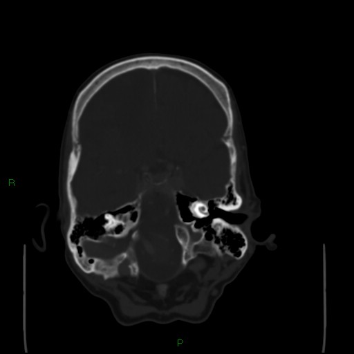 Cerebral metastases - breast primary (Radiopaedia 77653-89857 Axial bone window 33).jpg