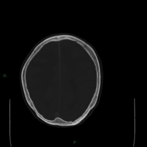 Cerebral metastases - breast primary (Radiopaedia 77653-89857 Axial bone window 83).jpg