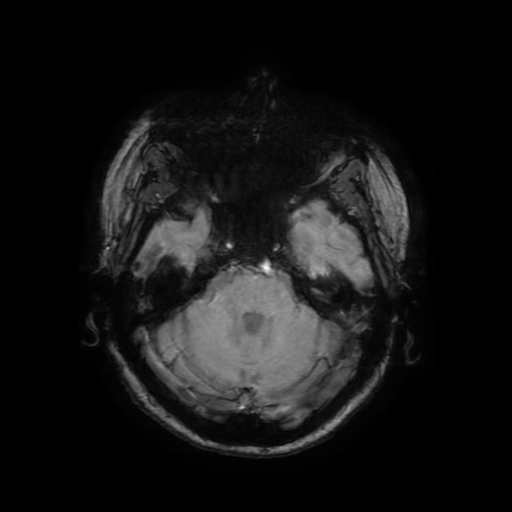 File:Cerebral metastases - melanoma (Radiopaedia 80972-94522 Axial SWI 28).jpg