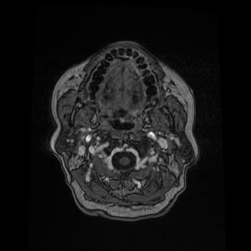 Cerebral metastases - melanoma (Radiopaedia 80972-94522 Axial T1 C+ 12).jpg