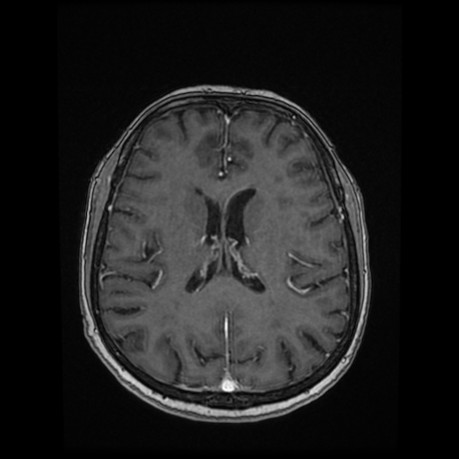 File:Cerebral metastases - melanoma (Radiopaedia 80972-94522 Axial T1 C+ 61).jpg