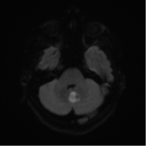 File:Cerebral metastases mimicking abscesses (Radiopaedia 45841-50131 Axial DWI 37).png