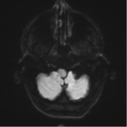 File:Cerebral metastasis - melanoma (Radiopaedia 54718-60954 Axial DWI 35).png