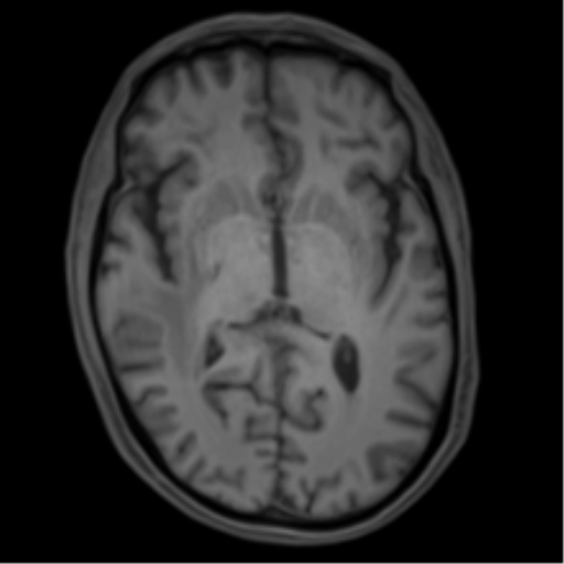 File:Cerebral metastasis - melanoma (Radiopaedia 54718-60954 Axial T1 26).png