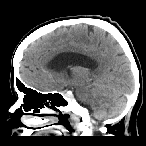 File:Cerebral metastasis to basal ganglia (Radiopaedia 81568-95412 Sagittal C+ delayed 33).png