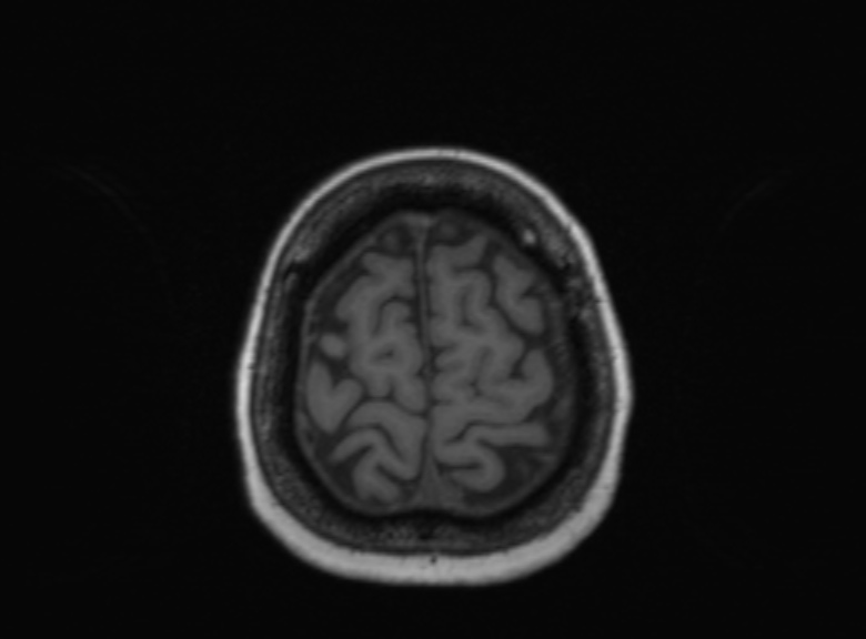Cerebral ring enhancing lesions - cerebral metastases (Radiopaedia 44922-48817 Axial T1 124).jpg