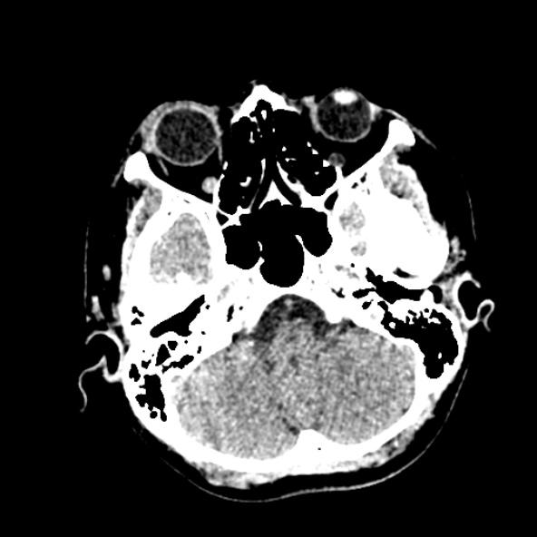 File:Cerebral ring enhancing lesions - cerebral metastases (Radiopaedia 44922-48818 Axial non-contrast 6).jpg