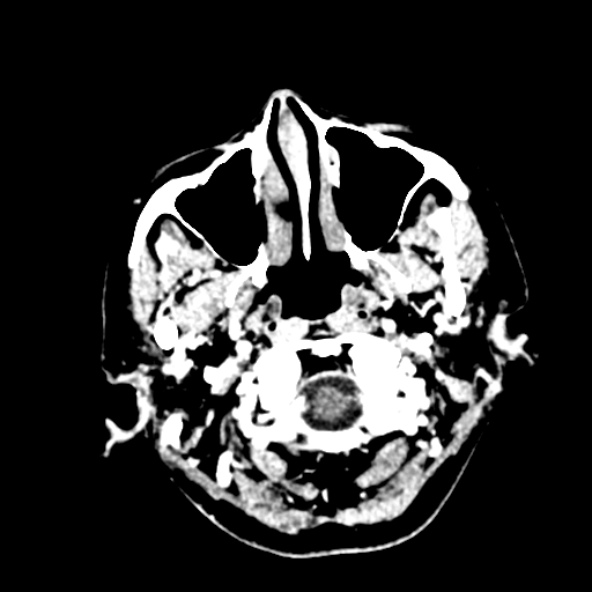 Cerebral ring enhancing lesions - cerebral metastases (Radiopaedia 44922-48818 B 19).jpg