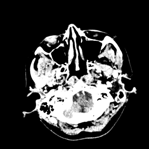 File:Cerebral ring enhancing lesions - cerebral metastases (Radiopaedia 44922-48818 B 35).jpg