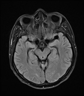 File:Cerebral toxoplasmosis (Radiopaedia 43956-47461 Axial FLAIR 9).jpg