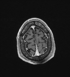 Cerebral toxoplasmosis (Radiopaedia 43956-47461 Axial T1 C+ 70).jpg
