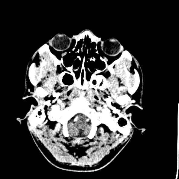 Cerebral toxoplasmosis (Radiopaedia 53993-60131 Axial C+ delayed 9).jpg