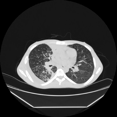 Cerebral tuberculoma (Radiopaedia 80829-94318 Axial lung window 87).jpg