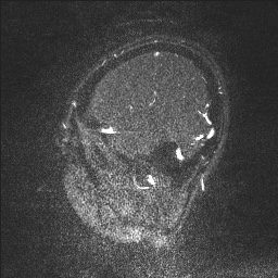 Cerebral tuberculosis with dural sinus invasion (Radiopaedia 60353-68090 Sagittal MRV 132).jpg