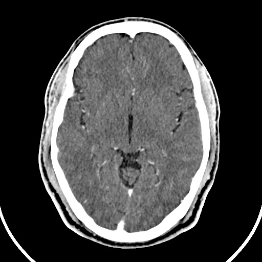 File:Cerebral venous angioma (Radiopaedia 69959-79977 B 39).jpg