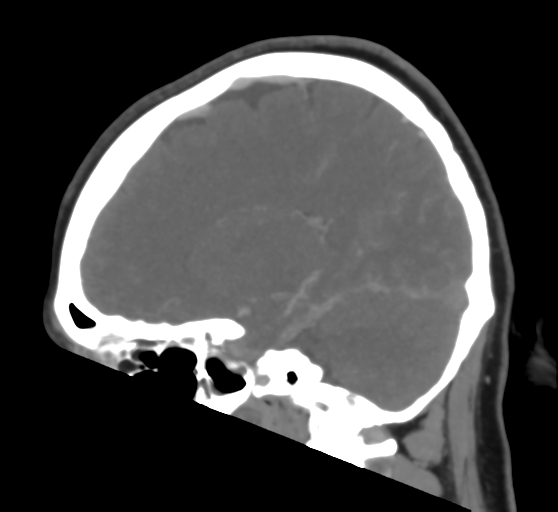File:Cerebral venous infarction due to transverse sinus thrombosis (Radiopaedia 34688-36120 Sagittal CT venogram 23).png
